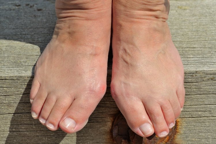 Bunion Treatments At Home Fortunate Feet