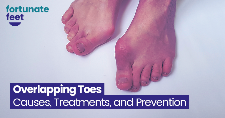 overlapping-toes-causes-treatments-and-prevention-fortunate-feet