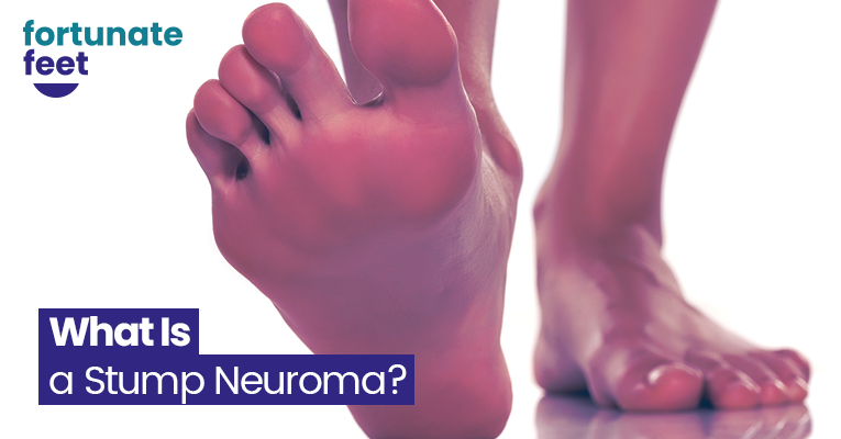 What Is a Stump Neuroma? Treatment and Options - Fortunate Feet