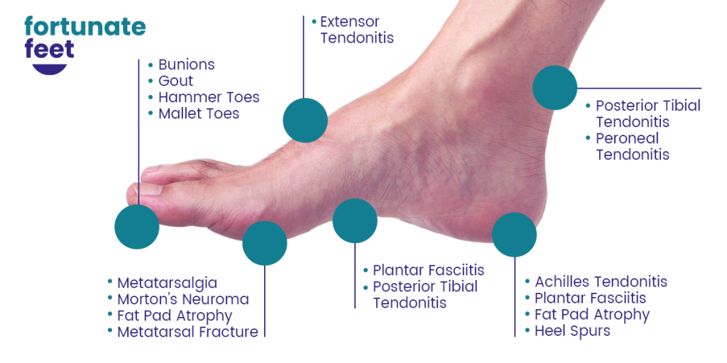 Foot Pain Chart - Common Symptoms and Causes - Fortunate Feet